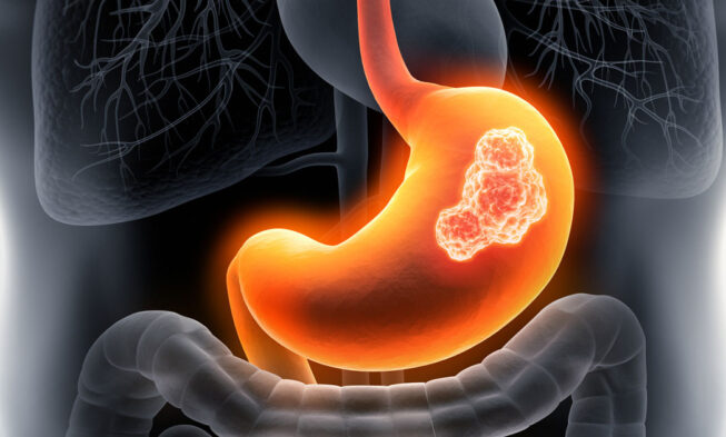 Unveiling the Best Colonoscopy Screening Services in Singapore img